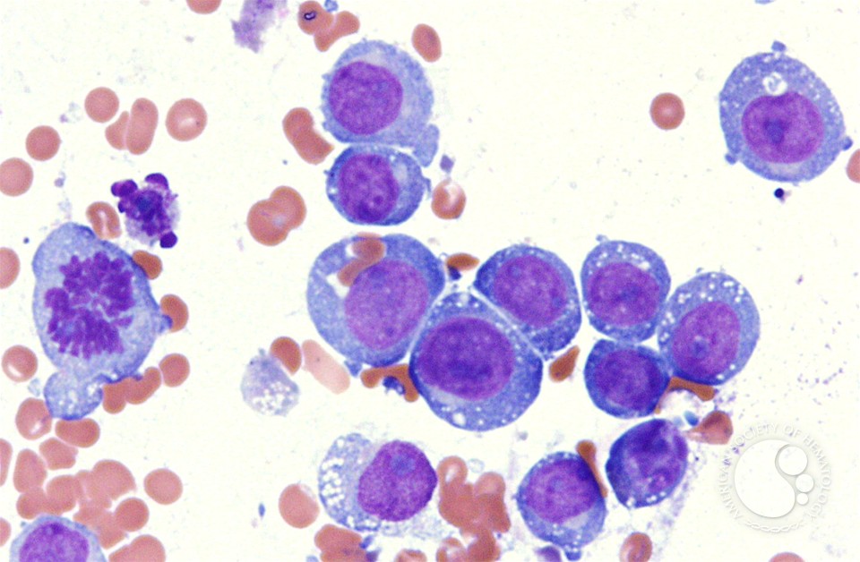 Erythrocyte hemophagocytosis by AML-M5a blasts - 2.
