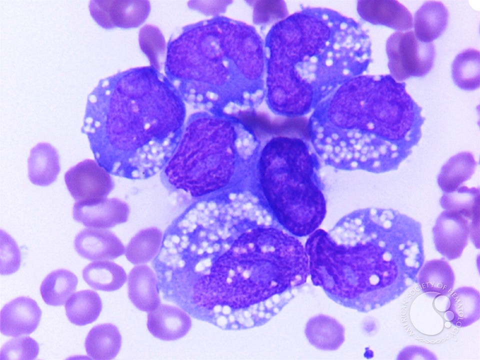 Acute myeloid leukemia with histiocytic differentiation - 1.