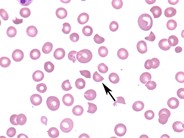 Schistocyte - 1.