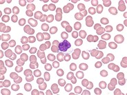 Large granular lymphocyte - 1.