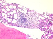 Systemic mastocytosis - 2.