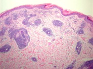 T-prolymphocytic leukemia cutis - 1.