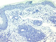 T-prolymphocytic leukemia cutis - 5.