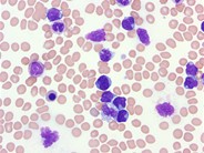 T-prolymphocytic leukemia - 1.