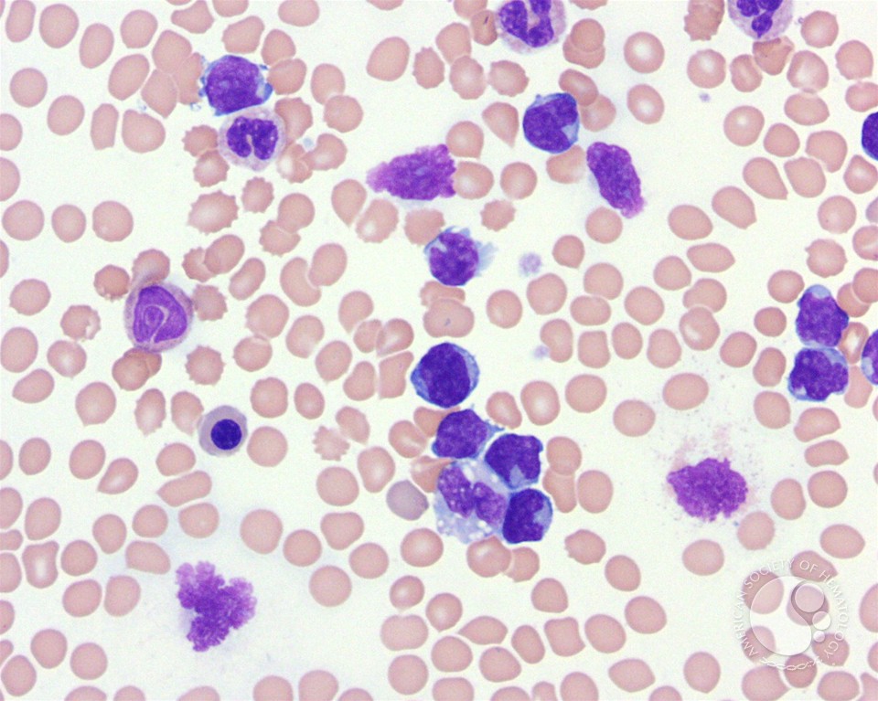 T-prolymphocytic leukemia - 1.