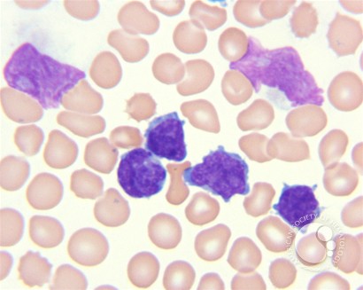 T-prolymphocytic leukemia - 2.