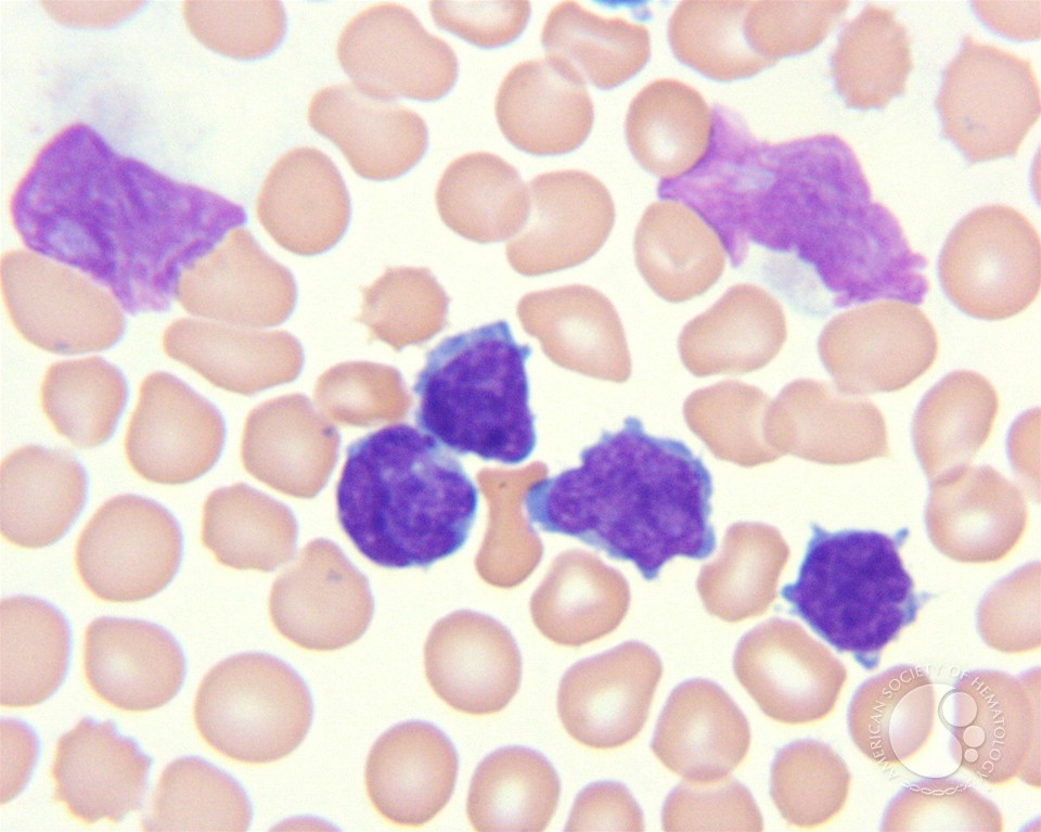 T-prolymphocytic leukemia - 2.