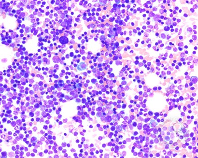 T-prolymphocytic leukemia - 3.