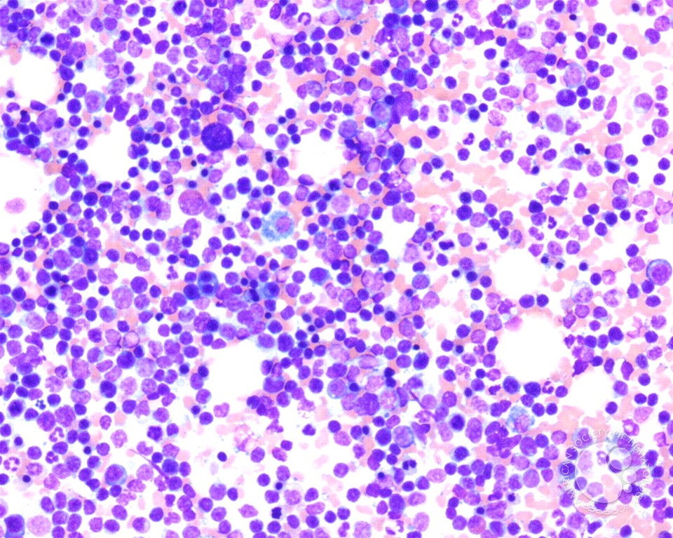 T-prolymphocytic leukemia - 3.