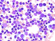 T-prolymphocytic leukemia - 4.