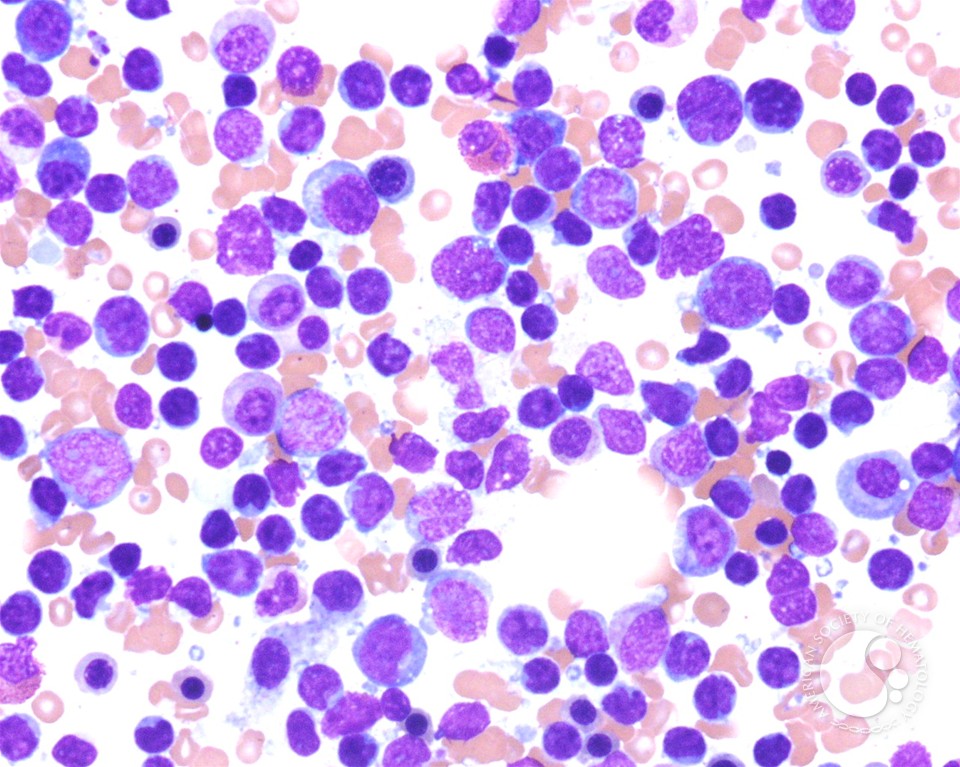 T-prolymphocytic leukemia - 4.
