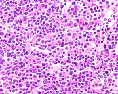 T-prolymphocytic leukemia - 5.