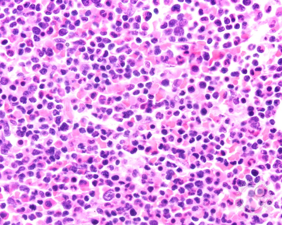 T-prolymphocytic leukemia - 5.