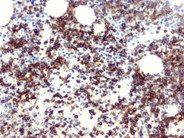 T-prolymphocytic leukemia - 6.