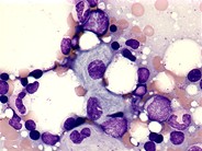 Gaucher’s disease - 3.