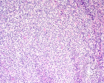 Diffuse Large B-cell Lymphoma, Anaplastic Variant - 1.