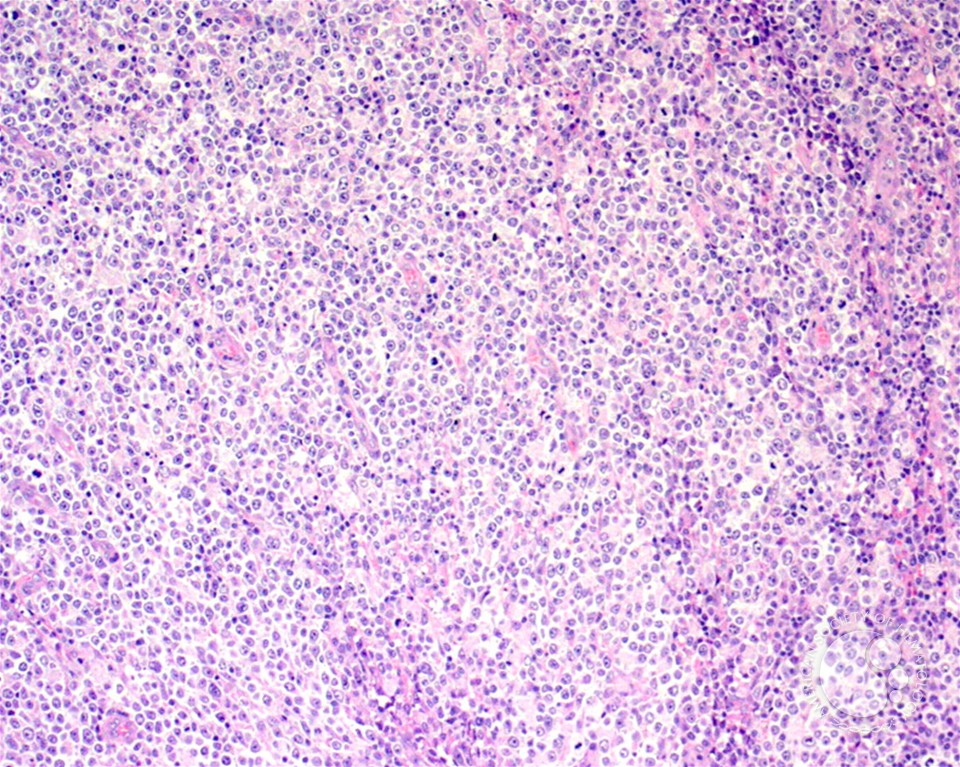 Diffuse Large B-cell Lymphoma, Anaplastic Variant - 1.
