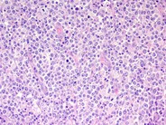 Diffuse Large B-cell Lymphoma, Anaplastic Variant - 2.