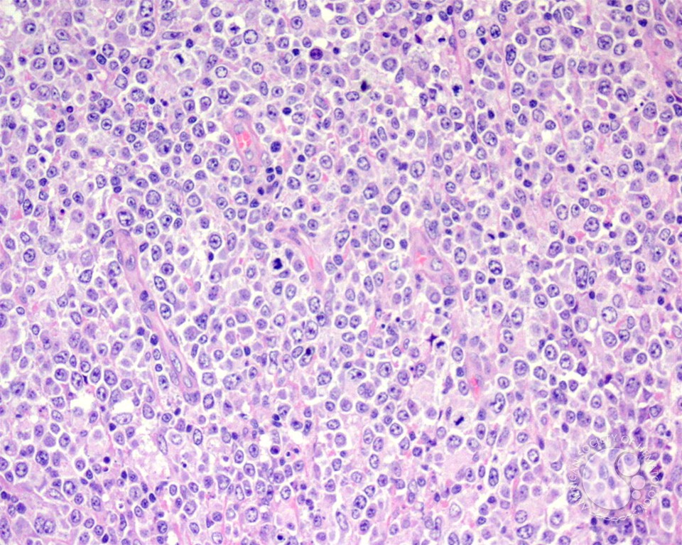Diffuse Large B-cell Lymphoma, Anaplastic Variant - 2.