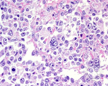 Diffuse Large B-cell Lymphoma, Anaplastic Variant - 3.