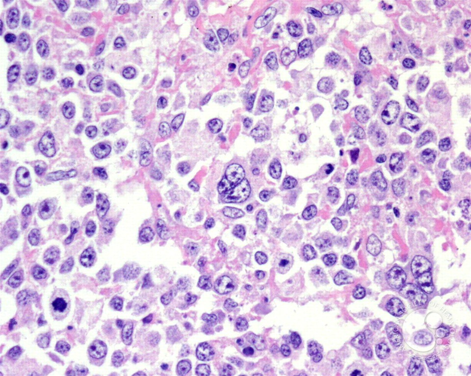 Diffuse Large B-cell Lymphoma, Anaplastic Variant - 3.