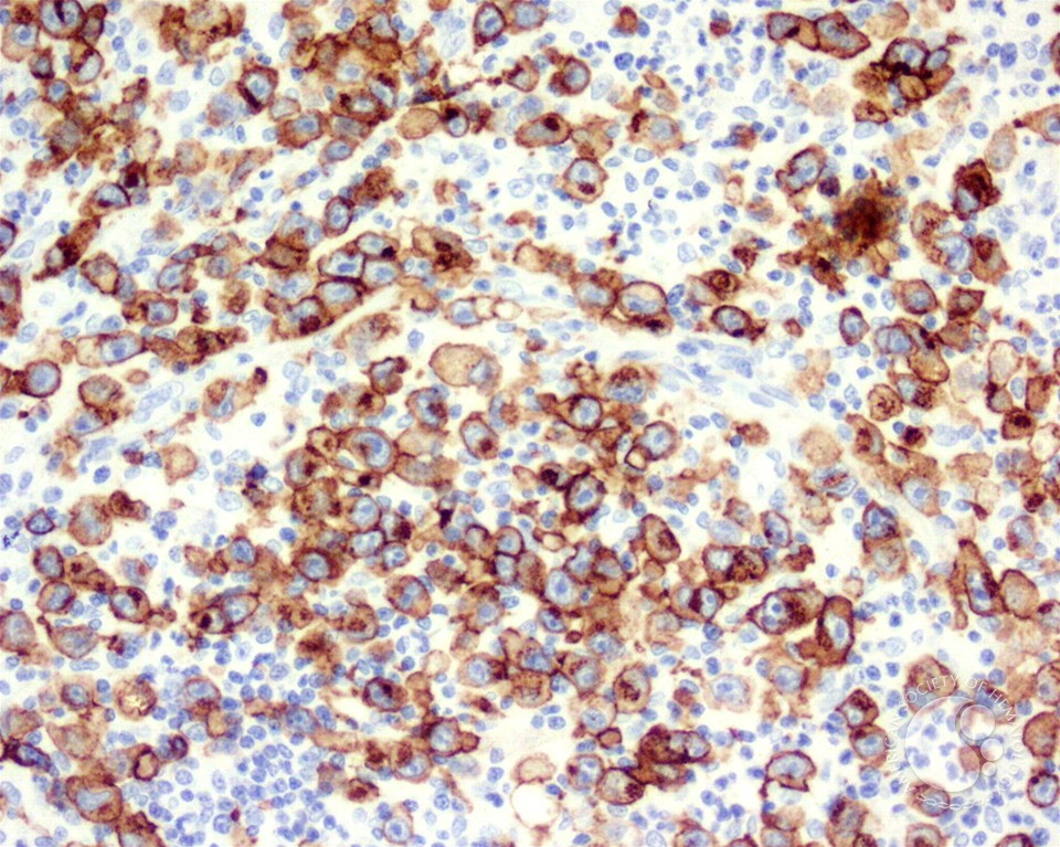 Diffuse Large B-cell Lymphoma, Anaplastic Variant - 5.