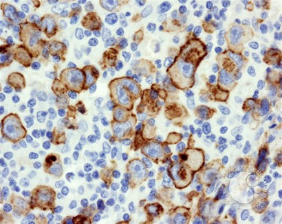 Diffuse Large B-cell Lymphoma, Anaplastic Variant - 6.