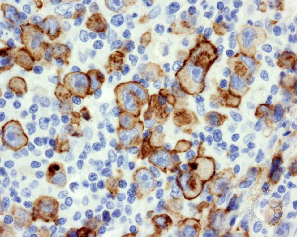 Diffuse Large B-cell Lymphoma, Anaplastic Variant - 6.