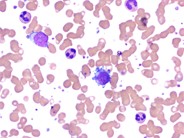 Micromegakaryocytes in peripheral blood smear - 1.