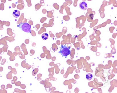 Micromegakaryocytes in peripheral blood smear - 1.