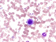 Micromegakaryocytes in peripheral blood smear - 3.