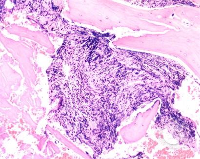 Marrow fibrosis in primary myelofibrosis - 1.