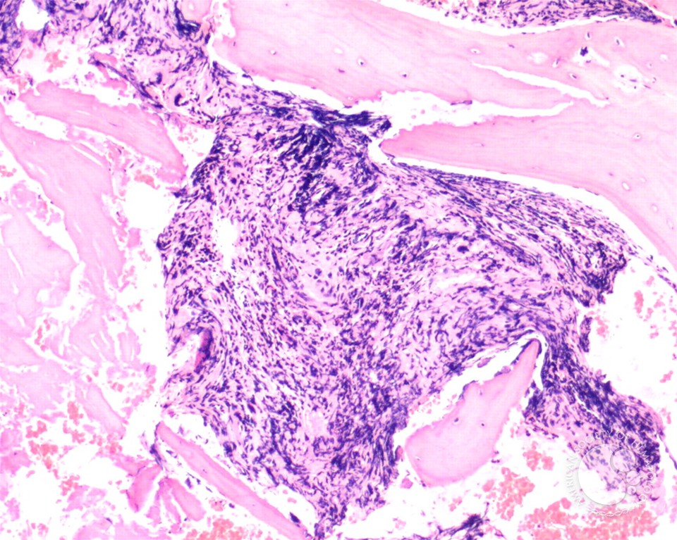 Marrow fibrosis in primary myelofibrosis - 1.