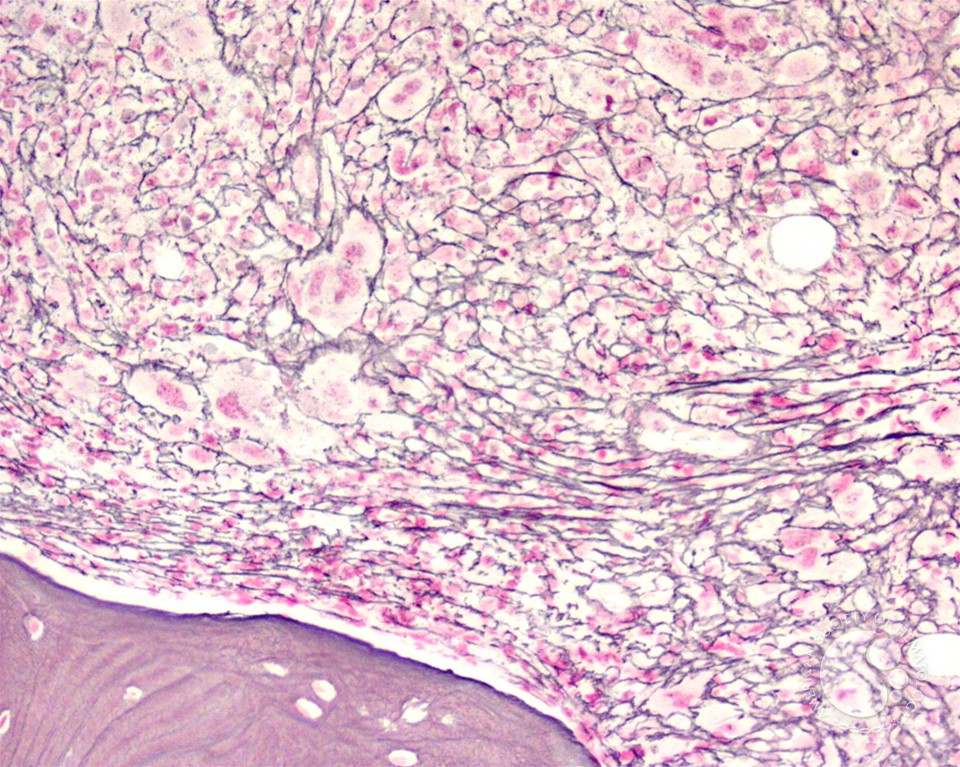 Marrow fibrosis in primary myelofibrosis - 2.