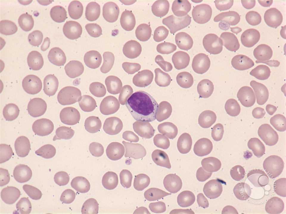 Large granular lymphocyte - 1.