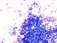 Hemophagocytic lymphohistiocytosis associated with AML-M5a - 2.