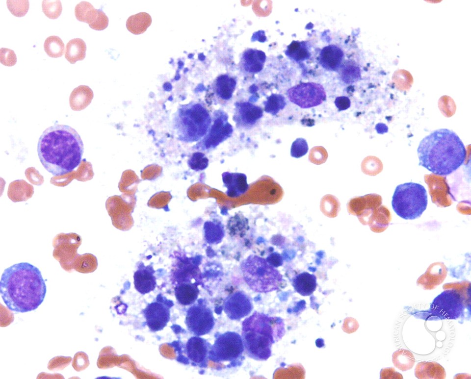 Hemophagocytic lymphohistiocytosis associated with AML-M5a - 3.