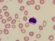 Large Granular Lymphocyte - 1.
