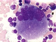 megakaryocyte in bone marrow