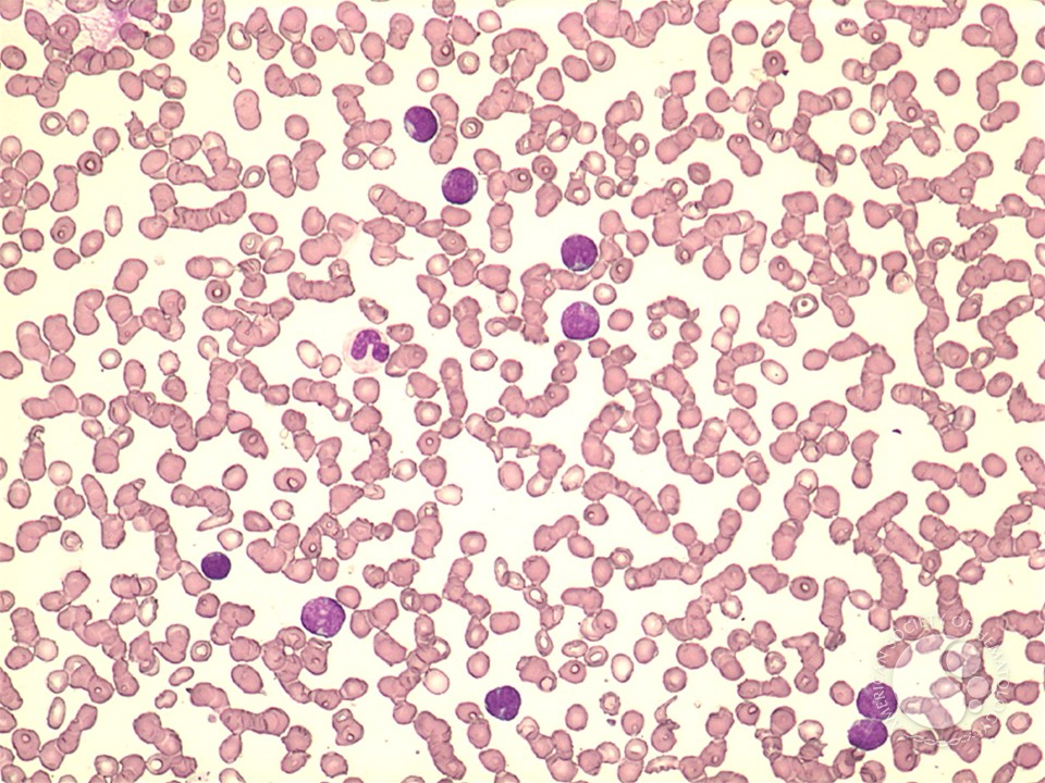 T-cell lymphoblastic leukemia - 1.