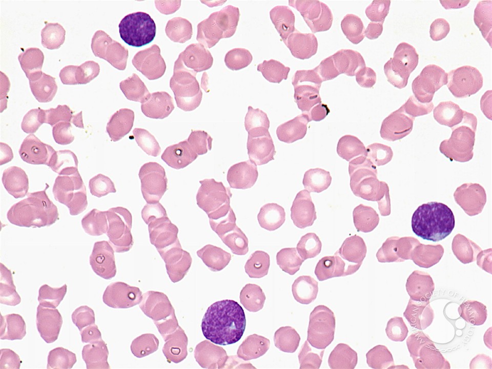 T-cell lymphoblastic leukemia - 2.