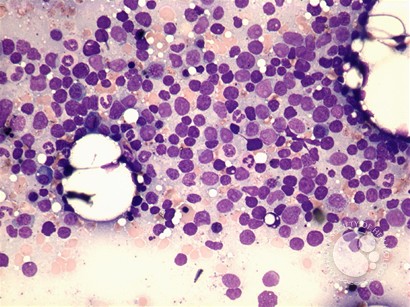 T-cell lymphoblastic leukemia - 4.