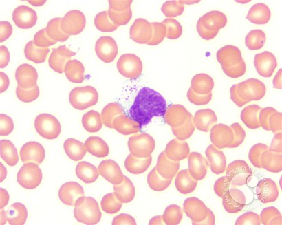 Large granular lymphocytes (LGLs) - 2.