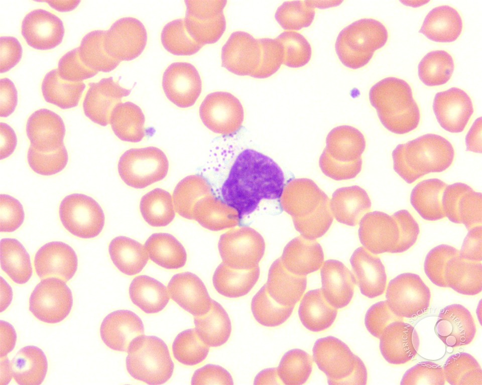 Large granular lymphocytes (LGLs) - 2.