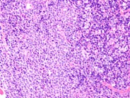 Mantle cell lymphoma - 1.