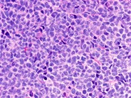 Mantle cell lymphoma - 2.