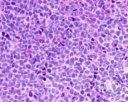 Mantle cell lymphoma - 2.