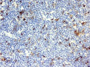 Mantle cell lymphoma - 4.