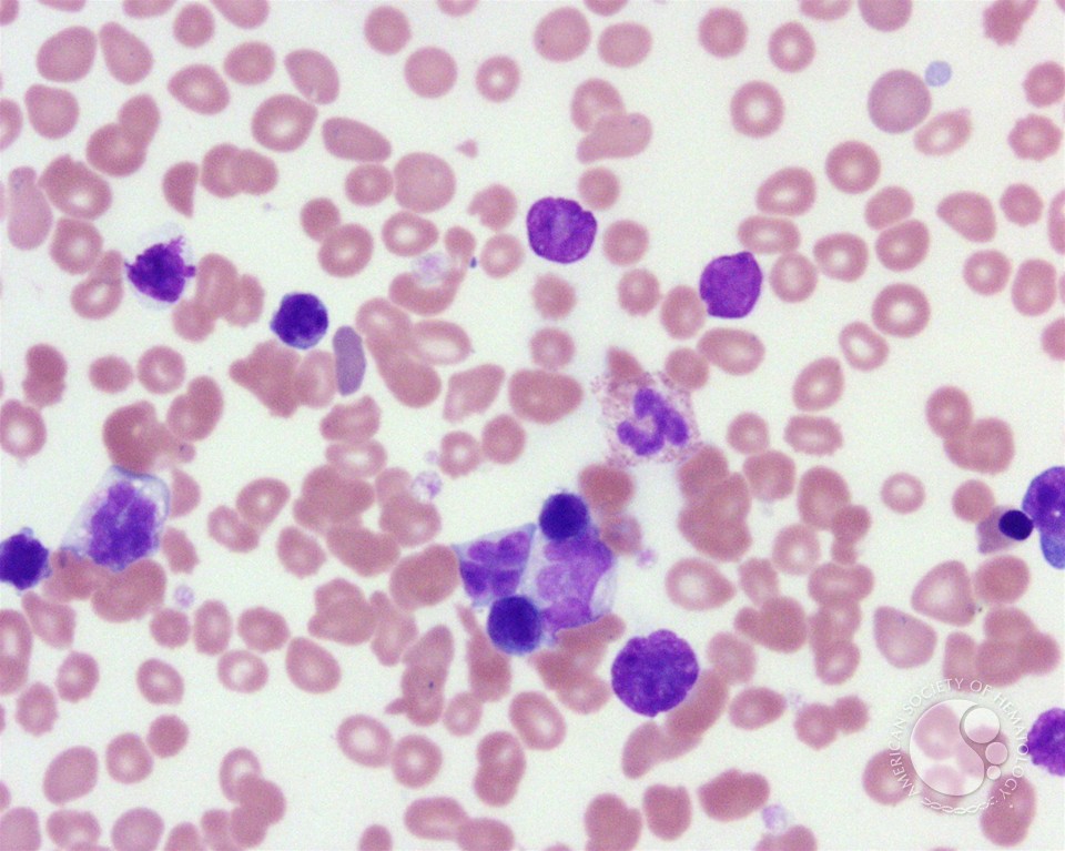 Adult T-cell leukemia/lymphoma peripheral smear - 1.