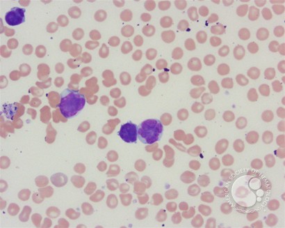 Adult T-cell leukemia/lymphoma peripheral smear - 2.